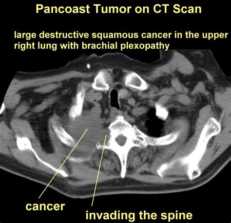 Pancoast tumor