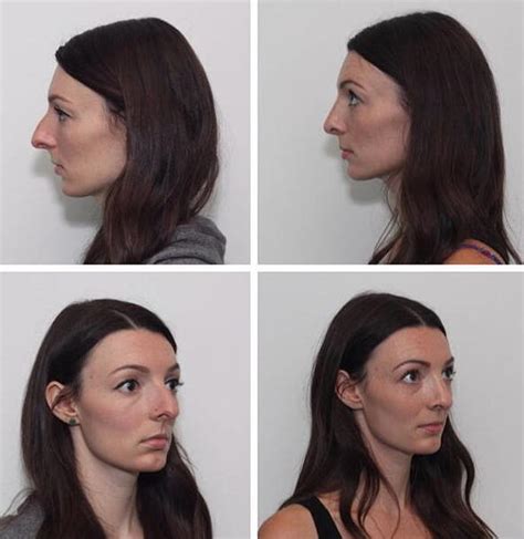 Deviated Septum Before And After (15) » Rhinoplasty: Cost, Pics ...