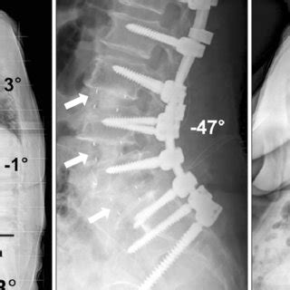 A 68-year-old female patient with degenerative flat back syndrome.... | Download Scientific Diagram