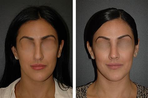 Rhinoplasty New York | New York Nose Job | Rhinoplasty NYC