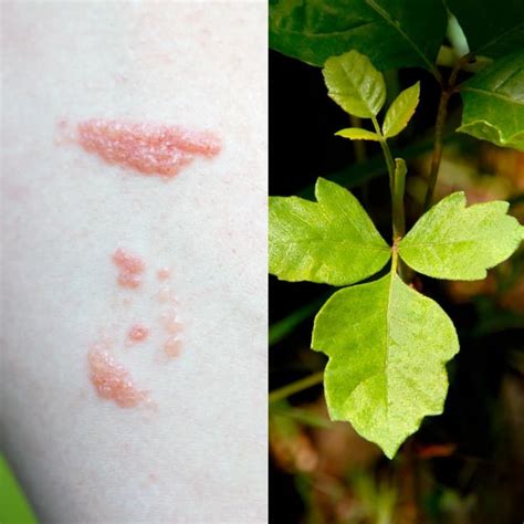 Poison Oak Rash Symptoms + 5 Soothing Natural Treatments - Dr. Axe ...