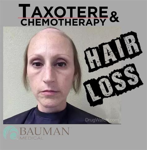 Taxotere Hair Loss and Baldness · Bauman Medical