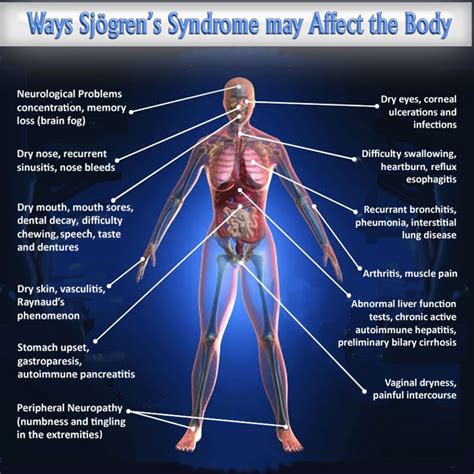 Many Symptoms Of Sjogren's Syndrome Are Neuropathic | Neuropathy and HIV