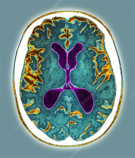 Alzheimer's disease, MRI scan - Stock Image - M108/0688 - Science Photo Library