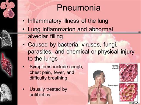 Does walking pneumonia need antibiotics