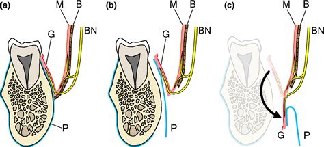 The course and distribution of the buccal nerve: clinical relevance in ...