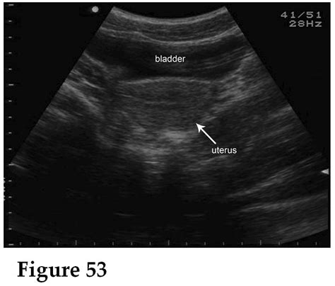 WK 1 L 2 PROLIFERATIVE PHASE IN TRANSVERSE UTERUS | OB/Gyn Ultrasound 101 Mod 2 | Pinterest ...