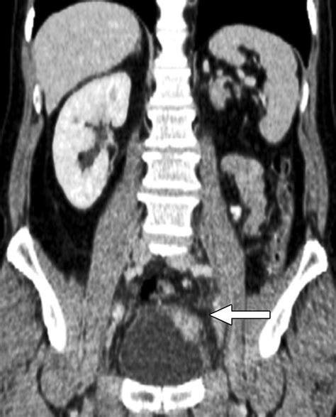 What Is A CT Urogram? Procedure, Uses, Risks, And Results, 59% OFF