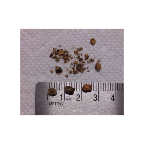 How Big Is A 2mm Kidney Stone - HealthyKidneyClub.com