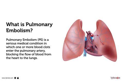 Pulmonary Embolism Treatment