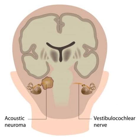 NSAIDs May Halt Growth of Vestibular Schwannomas | The Hearing Review