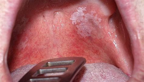 Risk Factors of Leukoplakia? | Leukoplakia causes and treatment