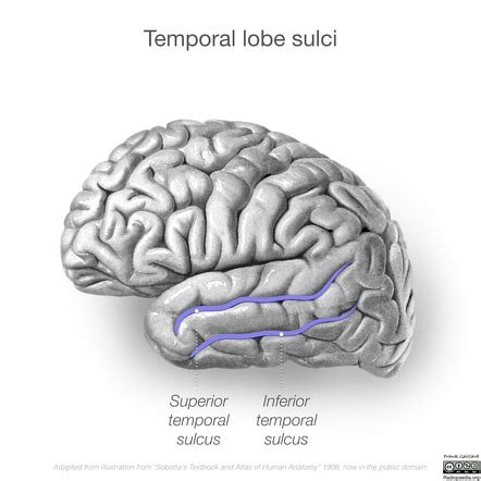 Superior temporal sulcus | Radiology Reference Article | Radiopaedia.org