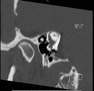 Temporal Bone Ct Anatomy - Anatomical Charts & Posters