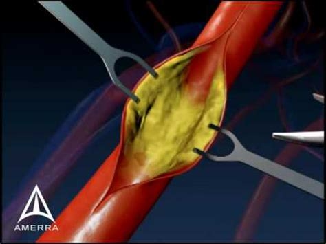 Carotid Endarectomy - 3D Medical Animation - YouTube