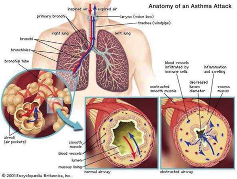 1. Anatomy of an Asthma Attack | Download Scientific Diagram