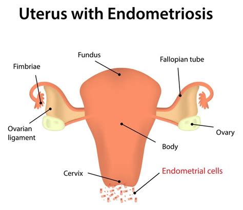 Fertility Treatment for Endometriosis - Los Angeles, CA