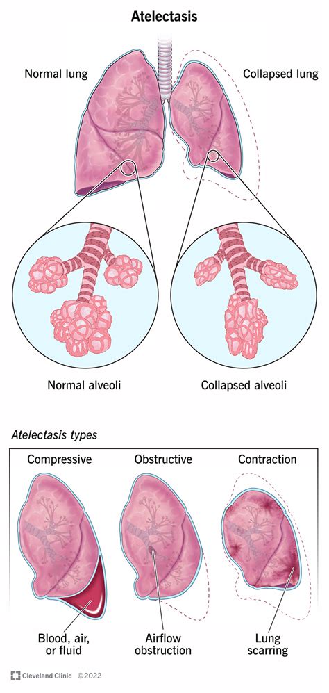 Basal Atelectasis X Ray