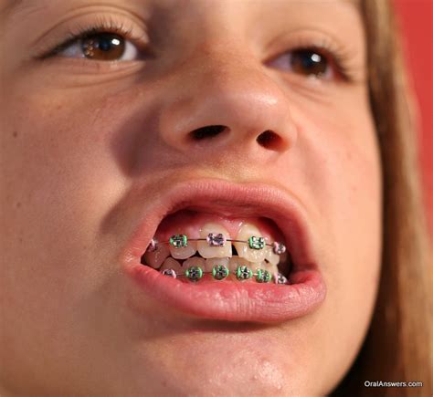 60 Photos of Teenagers with Braces - Robweigner's blog