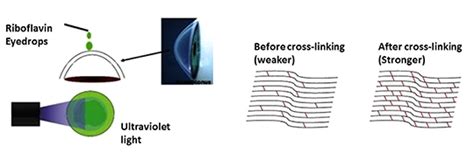 Corneal Cross-Linking | Casey Eye Institute | OHSU