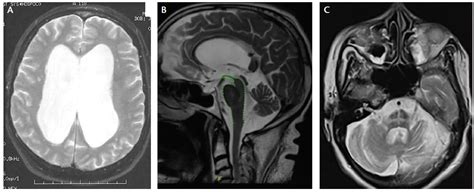 Imaging in Parkinson’s Disease - Practical Neurology