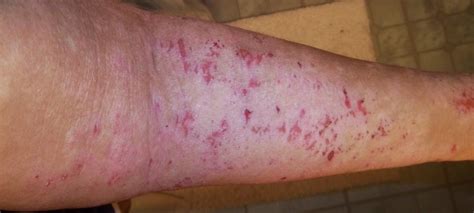 Why Topical Steroid Withdrawal May Be Causing Your Eczema Flare Ups | Eczema Conquerors