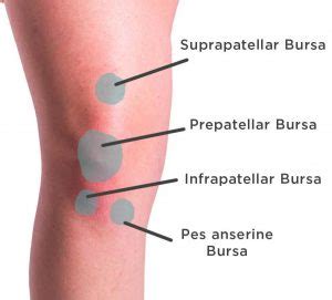 Knee Bursitis - Bakers cyst and Housemaids knee - Back in Action Physio