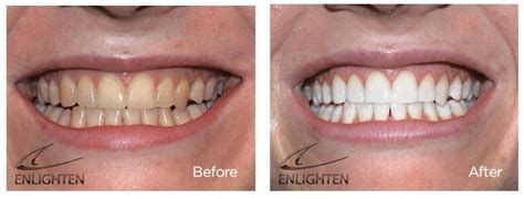 Teeth Stain Removal| Cowbridge| Amazing Clean Teeth