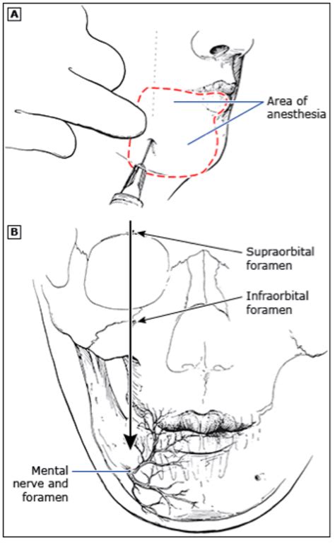 Maxillary Nerve Block Technique