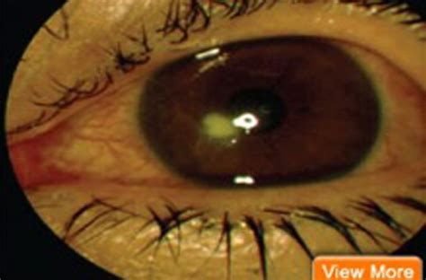 Corneal Ulcer