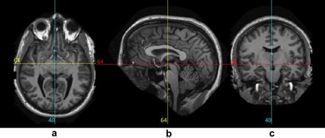 a: Axial view. b:Sagittal view. c:Coronal view of the brain [7 ...