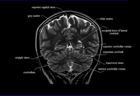 Cerebellum Anatomy Mri