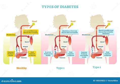 Diabetes Types Diagram