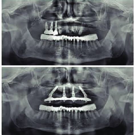 Orthopantomography of the patient before and after the "all-on-four ...