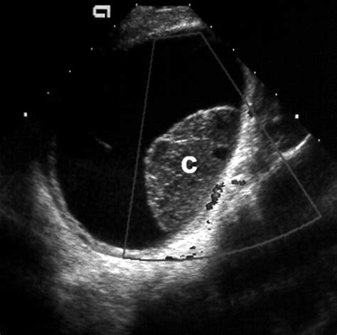 Sonographic Spectrum of Hemorrhagic Ovarian Cysts - Jain - 2002 ...