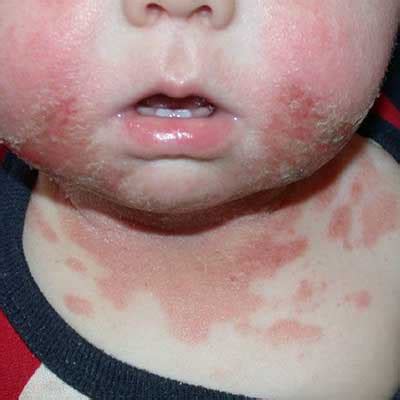 Pictures of Skin Allergies in Children