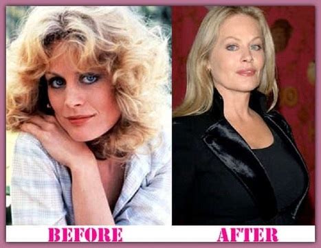 Beverly D Angelo Plastic Surgery Before & After - Celebrity ...