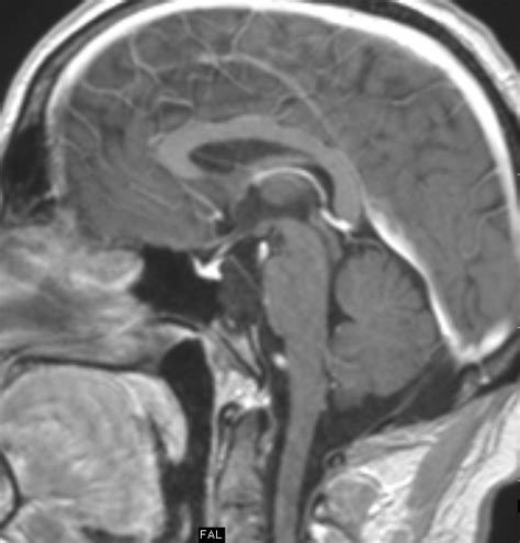 Clival Epidermoid-MRI - Sumer's Radiology Blog