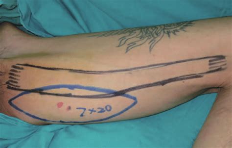 Profunda artery perforator flap | doctorvisit