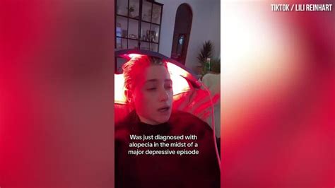 Lili Reinhart shares she has been diagnosed with alopecia - PopBuzz