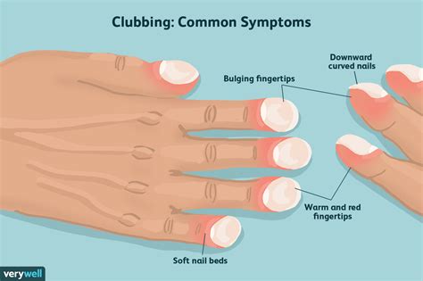 Finger Clubbing: Symptoms, Causes, Diagnosis, and Treatment