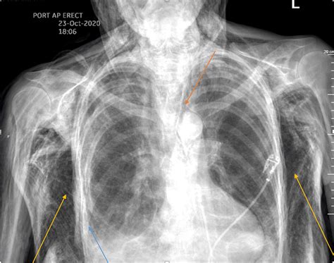 Subcutaneous Emphysema