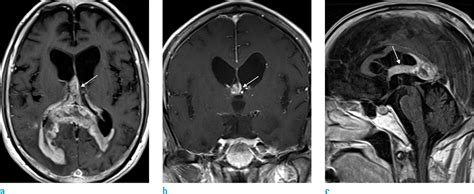 The Fornix: Functional Anatomy, Normal Neuroimaging, and Various ...