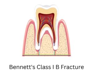 Bennett's Classification of Tooth Fracture - Dental Dictionary