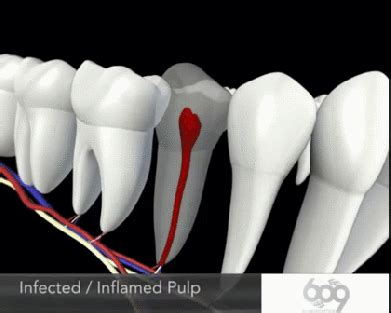 Animated Wisdom Teeth Removal Gif | Best Wallpaper - Best Wallpaper HD