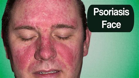 Psoriasis Face, Home Remedies For Scalp Psoriasis, Natural Remedies For Scalp Psoriasis - YouTube