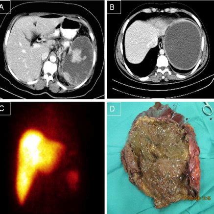 a. Contrast CT scan of patient 1 showing more than 80% splenic ...