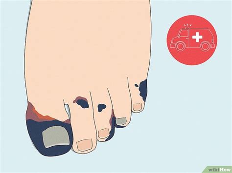 How to Treat Trench Foot: Symptoms & Causes (With Pictures)