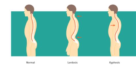 Kyphosis Treatment, Causes & Symptoms | QI Spine Clinic