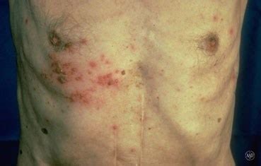 Herpes Zoster (Shingles) - Pariser Dermatology